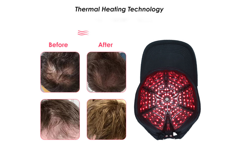 PREORDER - Biomol - Red Light Therapy Cap for Hair Growth with Smart Controller