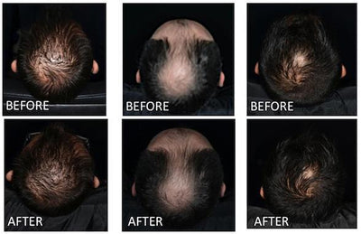 iRestore - Anti-Hair Loss Serum - Relaxacare